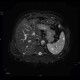Hamartomas of spleen, hamartoma: MRI - Magnetic Resonance Imaging